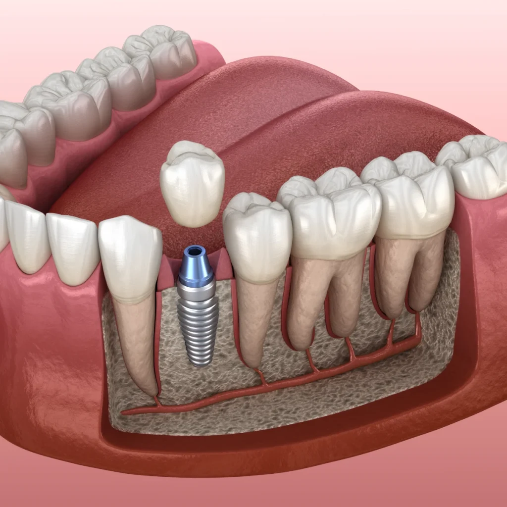 Chirurgie muco-gingivale et péri-implantaire