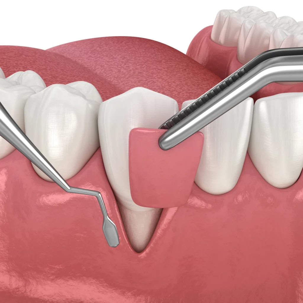 Chirurgie muco-gingivale et péri-implantaire